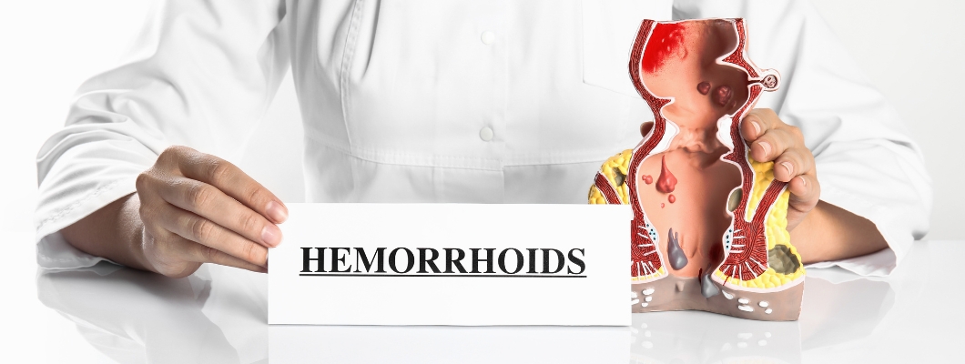 Hemorroides externas - Causas, síntomas y tratamiento
