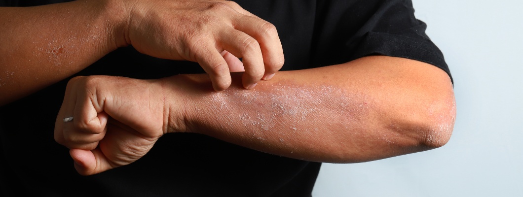 Eczema: cómo reconocerlo y tratarlo eficazmente