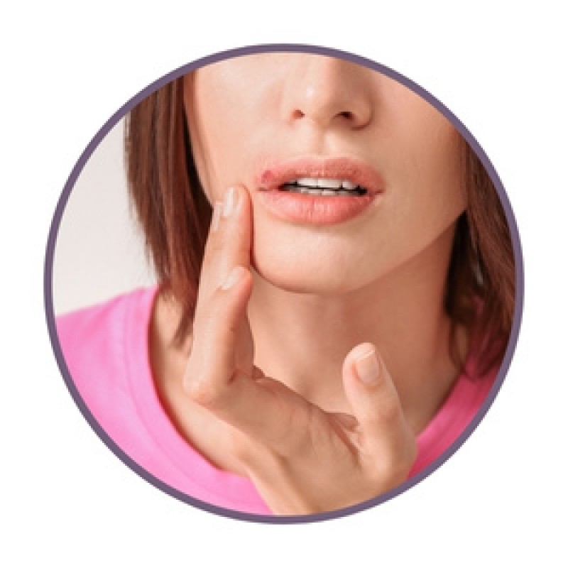 Pomadas para herpes labial