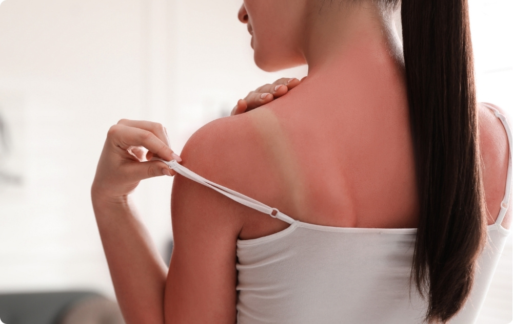 Como loción calmante para después del sol